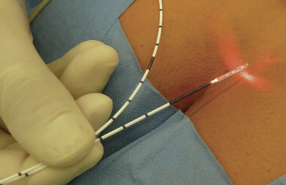 Dra. Marcella Conz Coloproctologia, Laser em coloproctologia
▫️Doenças Inflamatórias Intestinais  São Bernardo do Campo
